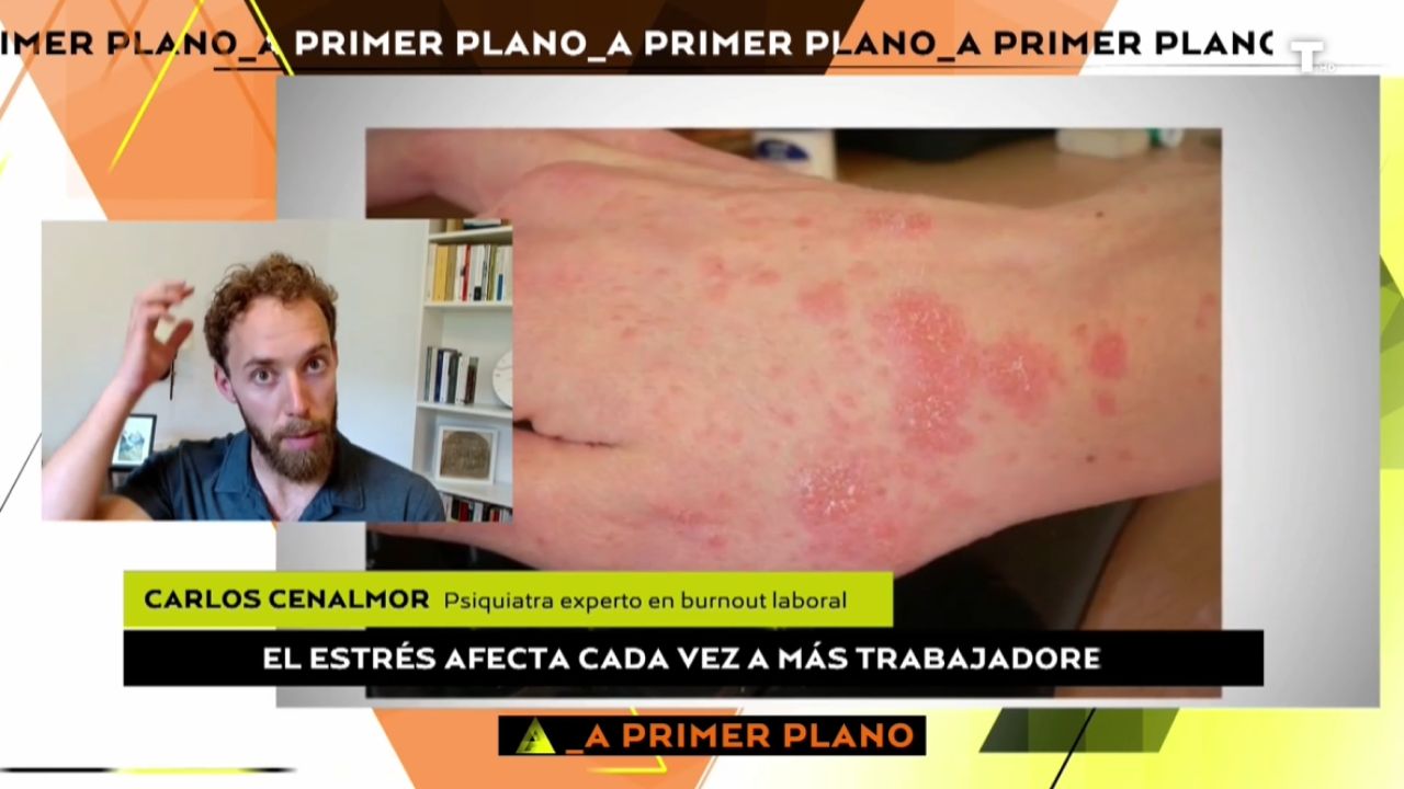 “Pérdida de pelo, eccemas, psoriasis…” Así habla la piel de nuestra salud mental 